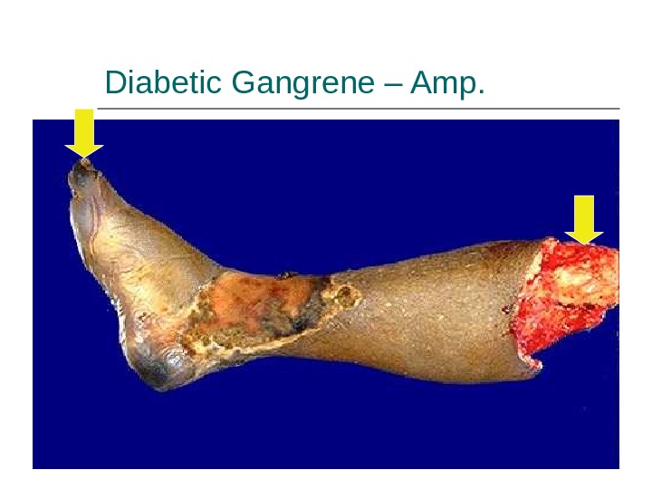 Презентация complications of Diabetes Mellitus A