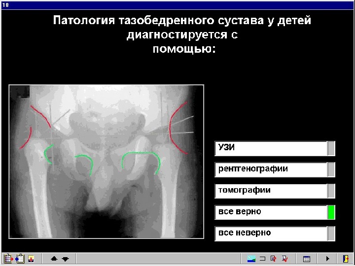 Дисплазия тазобедренного сустава у детей презентация