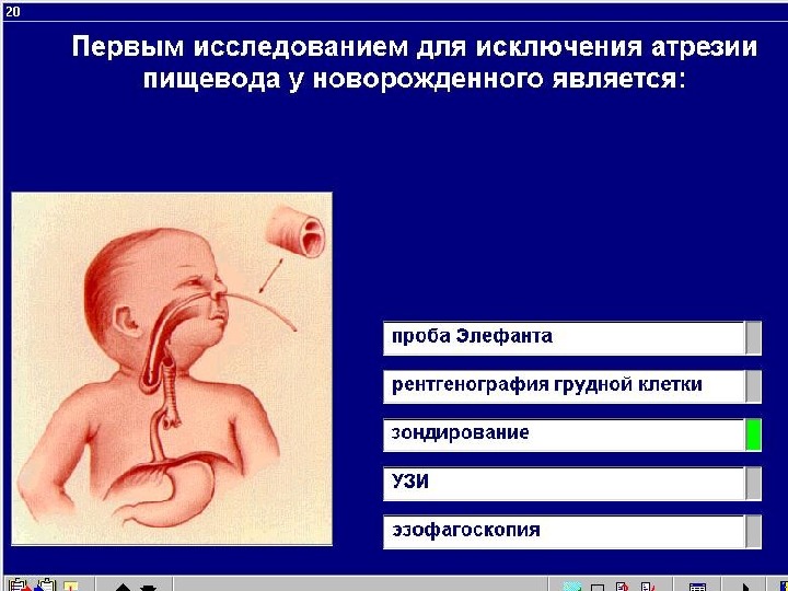 Атрезия пищевода у новорожденных презентация