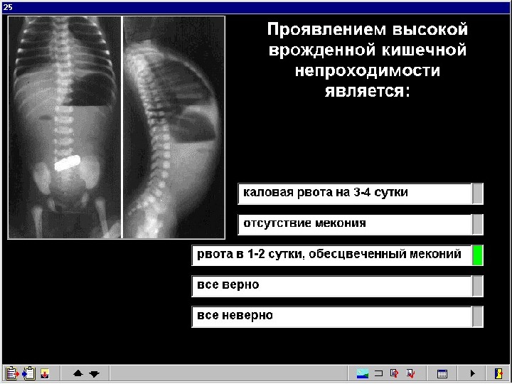 Врожденная кишечная. Врожденная высокая кишечная непроходимость рентген. Высокая кишечная непроходимость у детей рентген. Врожденная низкая кишечная непроходимость рентген. Низкая кишечная непроходимость рентген.