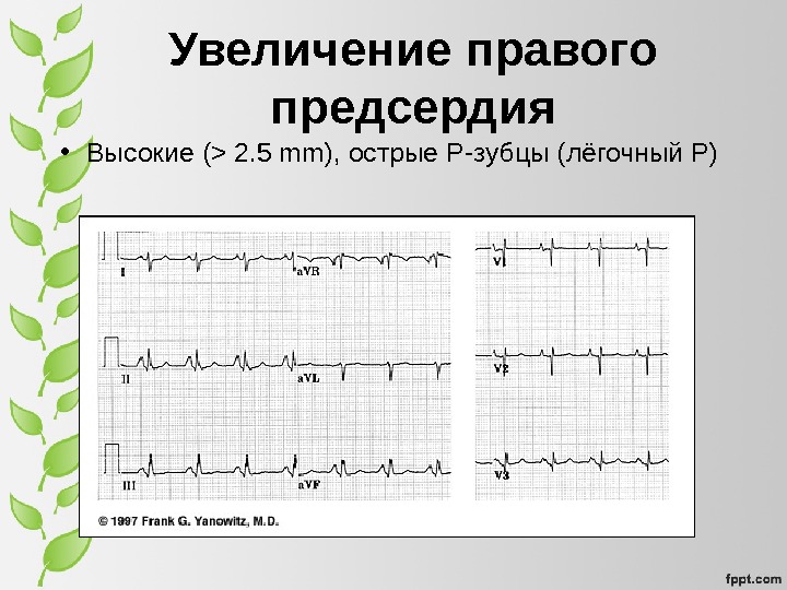 Увеличение интервала pq