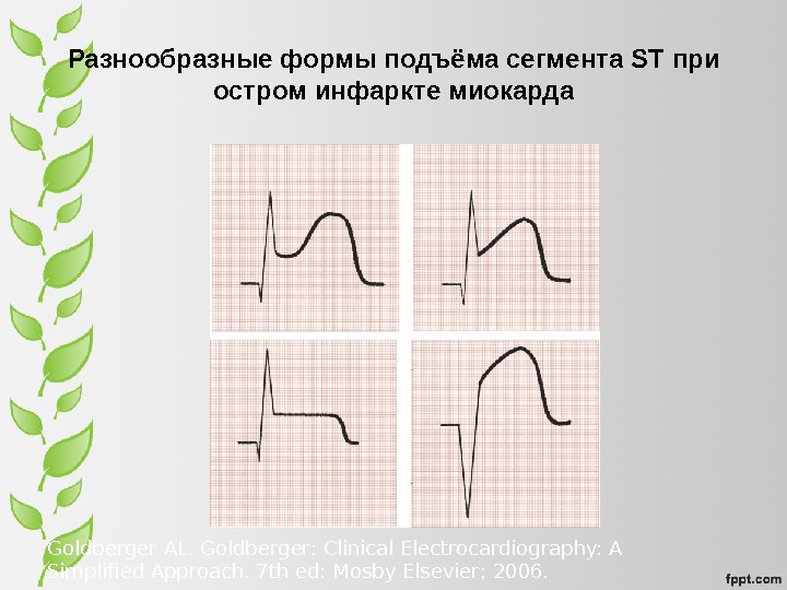 Подъем сегмента st. Инфаркт миокарда с подъемом сегмента St ЭКГ. Подъем сегмента St на ЭКГ. Подъем ст на ЭКГ. Подъем ст при инфаркте.