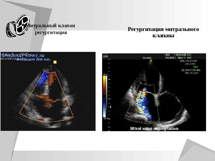 Митральная регургитация 2 степени. Регургитация митрального клапана. Митральная регургитация 1 степени. Регургитация клапана. Трикуспидальная регургитация 1.