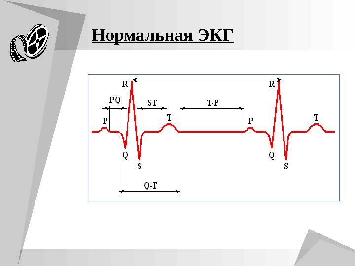 Рисунки на экг