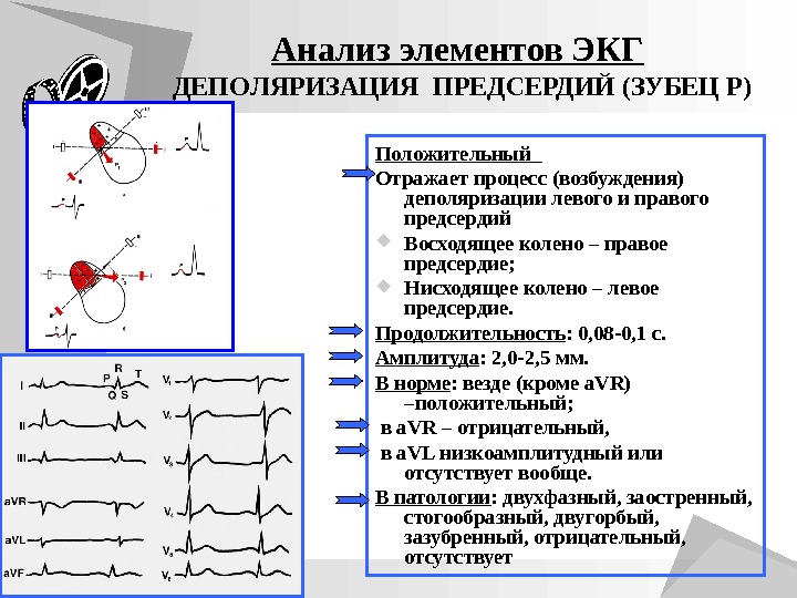 Низкоамплитудные отведения экг