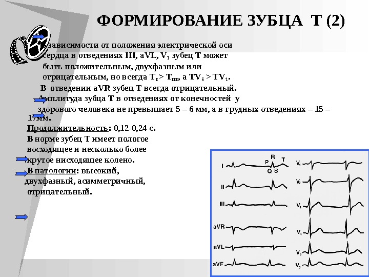 Высокий т. Отрицательный зубец т в 3 и AVF И V 1. Двухфазный зубец s в v1. Отрицательные зубцы т на ЭКГ В v2 v5. ЭКГ отрицательный зубец т в 1 отведении в AVL.