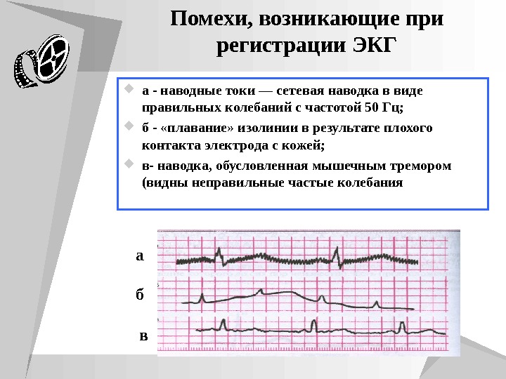 Экг примеры презентация