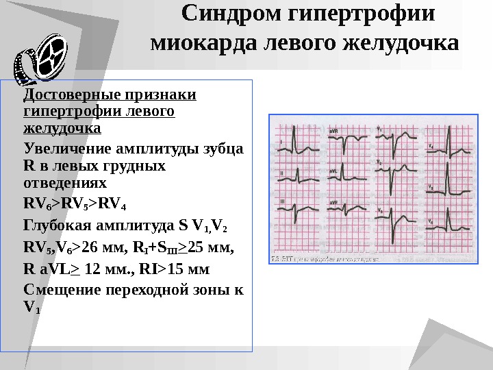 Аускультативная картина при гипертрофии левого желудочка