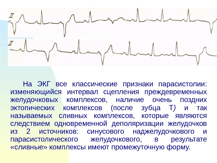 Комплексы экг. Сливные комплексы на ЭКГ при парасистолии. ЭКГ критерии парасистолии желудочковой. Сливные желудочковые комплексы на ЭКГ. Сливной комплекс на ЭКГ желудочковая экстрасистола.