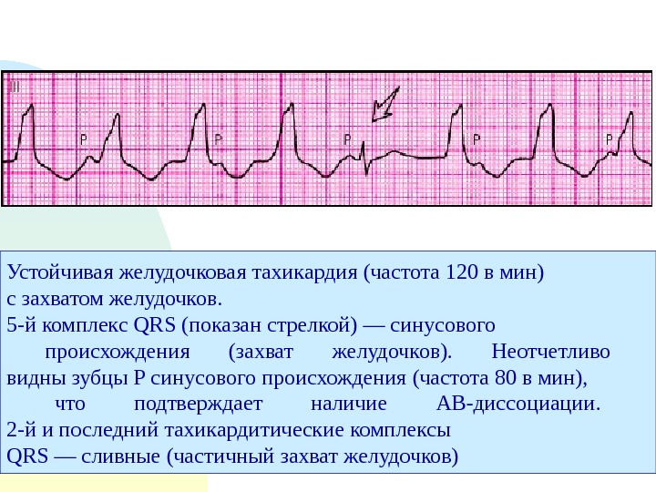 Желудочковая тахикардия на экг. Пароксизмальная тахикардия желудочков ЭКГ. Описание ЭКГ при пароксизмальной желудочковой тахикардии. Пароксизмальная желудочковая тахикардия на ЭКГ. ЭКГ при желудочковой пароксизмальной тахикардии.