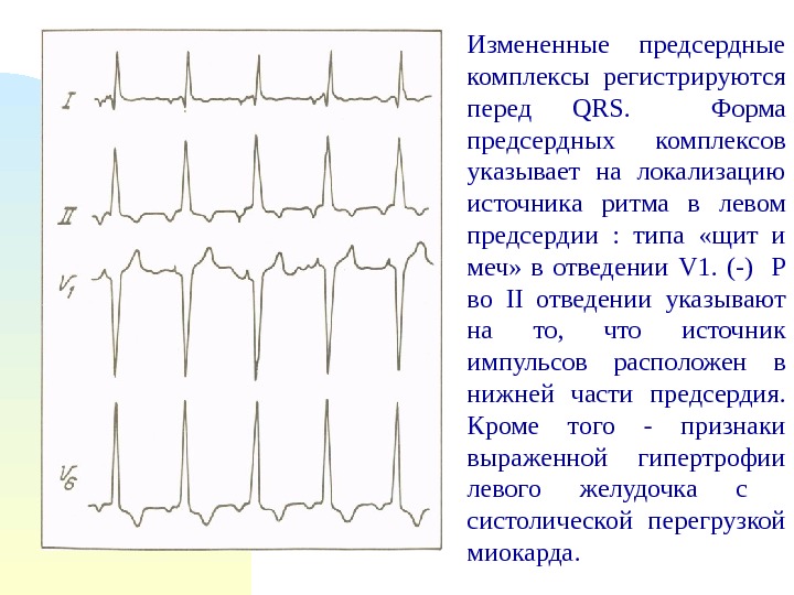 Предсердный ритм. Зубец р формы щит и меч. Расширенные комплексы QRS во всех отведениях. Формы комплекса QRS v1. Комплекс QRS Изменен.