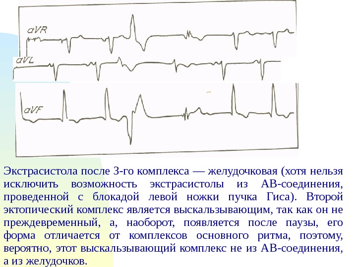 Частые желудочковые экстрасистолы карта вызова