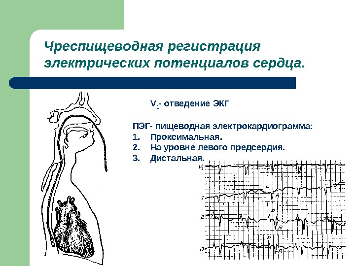 В виде чего регистрируются электрические импульсы сердца. Чреспищеводный метод ЭКГ. Чреспищеводная электрокардиостимуляция предсердий. Пищеводные отведения ЭКГ. Чреспищеводная электрокардиография (ЭКГ).
