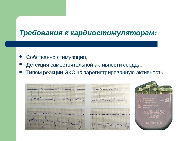 Экг с кардиостимулятором картинки