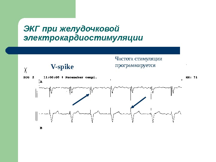 Экг с кардиостимулятором картинки