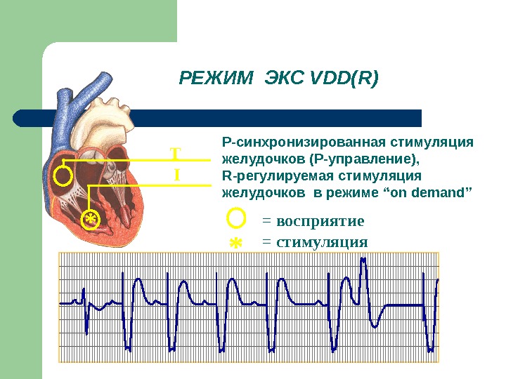 Экг с кардиостимулятором картинки