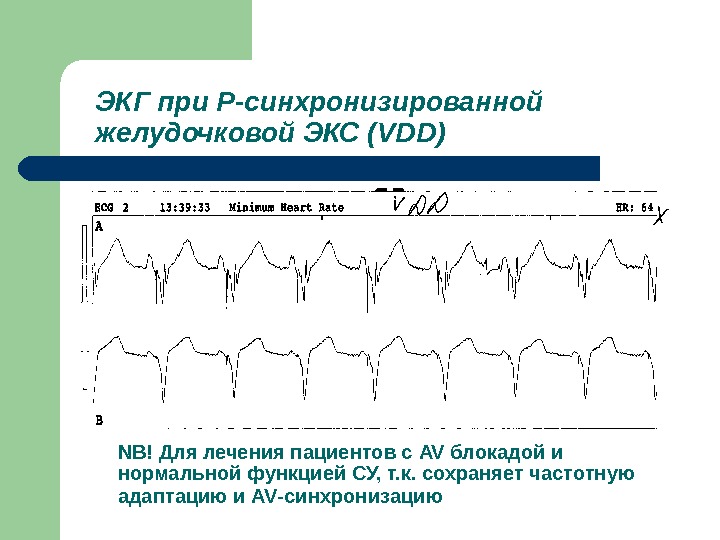 Экс контакты. Р синхронизированная стимуляция на ЭКГ. Р синхронизированная стимуляция желудочков на ЭКГ. Ритм искусственного водителя ритма на ЭКГ. Желудочковый ритм на ЭКГ.