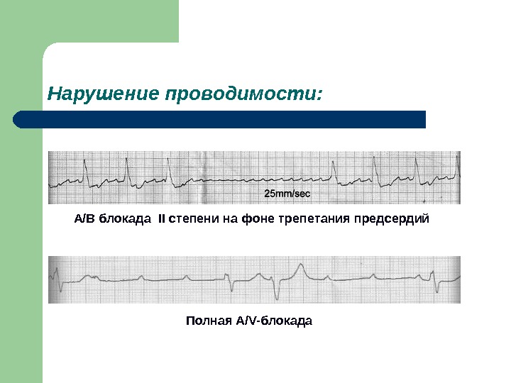 Нарушение проводимости. Нарушение проводимости предсердий. Патология проводимости виды блокад. Нарушение проводимости блокада 2 степени. Трепетание предсердий на фоне полной блокады.