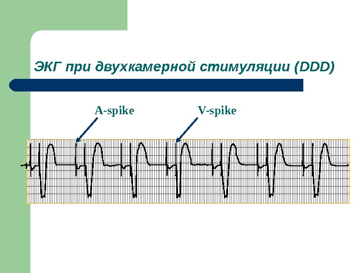 Экг с кардиостимулятором картинки