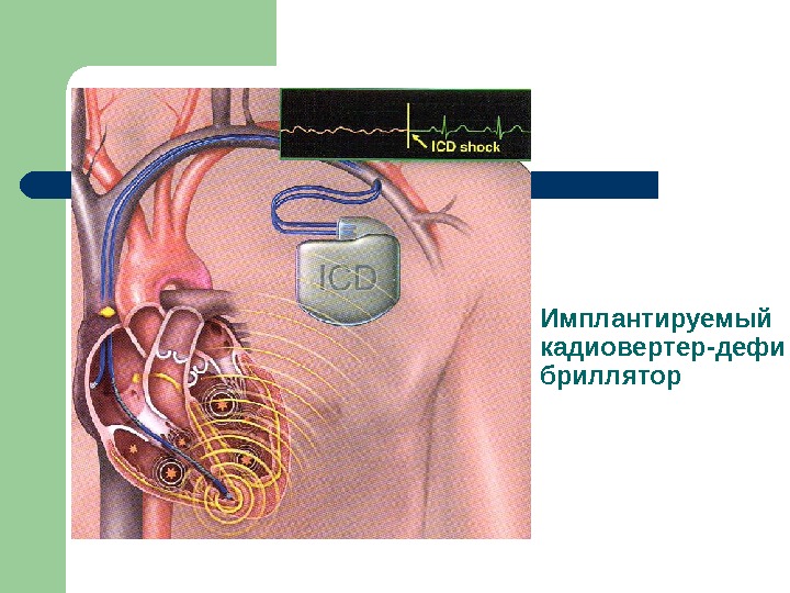 Кардиостимулятор сердца картинки