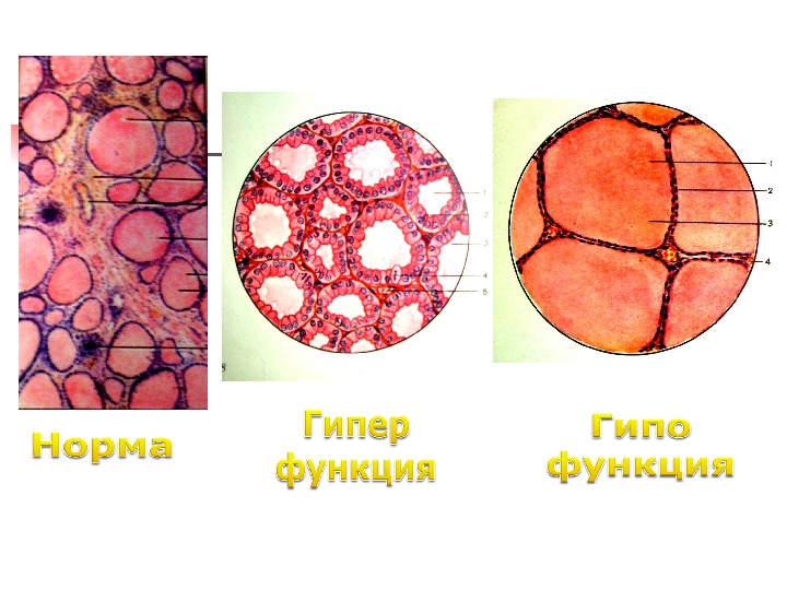 Гипо. Гиперфункция щитовидной железы гистология. Гипофункция щитовидной железы гистология. Гипофункция и гипофункция щитовидной железы гистология. Гипо и гиперфункция щитовидной железы гистология.