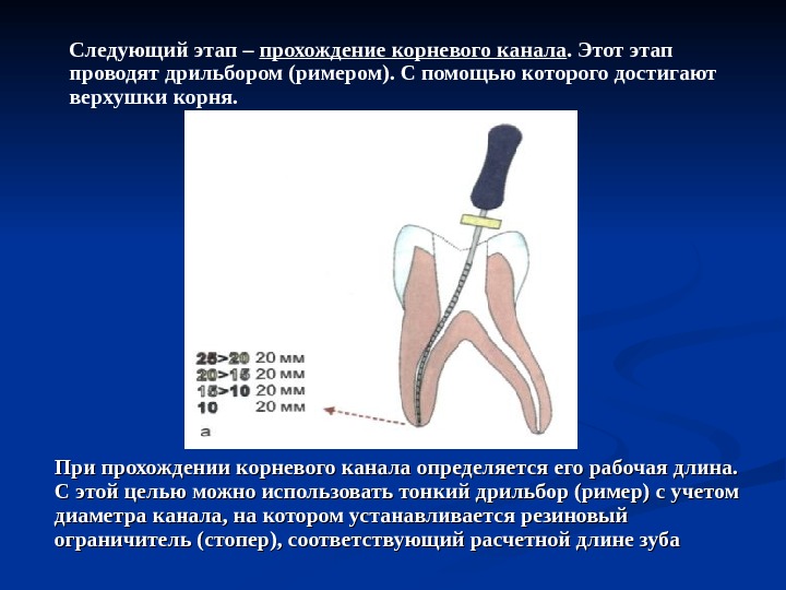 Повторное эндодонтическое лечение презентация