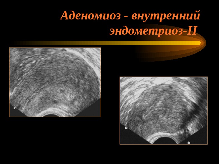 Как выглядит эндометриоз на узи в матке фото
