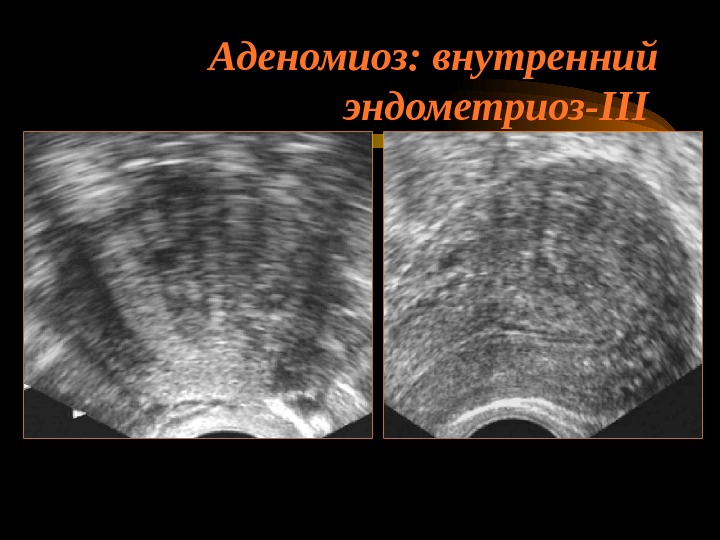 Эндометриоз видно на узи. УЗИ картина аденомиоз матки. Узловая форма аденомиоза по УЗИ.