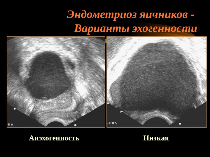 Эндометриоз видно на узи. Эндометриоидная киста яичника. Эндометриоидная киста брюшины. Эндометриоз матки снимки УЗИ. Эндометриоидная киста на УЗИ.