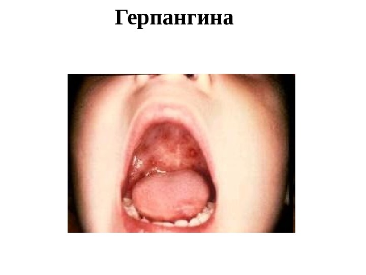 Презентация Энтеровирусная инфекция