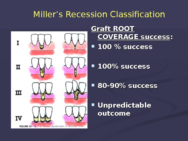 Классификация миллера. Классификация Миллера рецессии десны. Классификация рецессии десны по Миллеру. Рецессия классификация Миллера. Классификация рецессий по Miller.