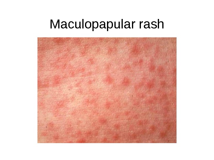 Fever and Rash Marcellina Mian Professor of Pediatrics