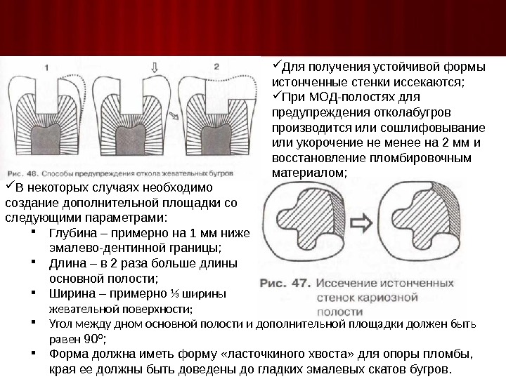 Дополнительные площадки кариозной полости. Требования предъявляемые к сформированной кариозной полости. Препарирование 2 класса по Блэку с дополнительной площадкой. Дополнительная площадка стоматология. Доп площадка кариозной полости.