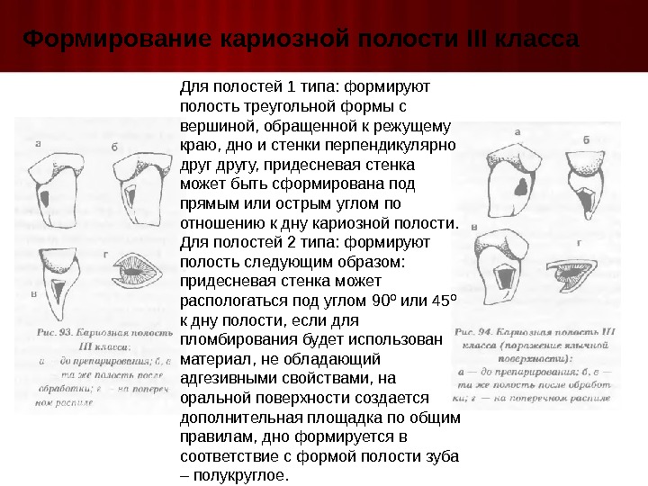 Форма кариозной полости. Формы кариозных полостей 1 класса. Пломбирование кариозных полостей 1 класса. Формирование кариозной полости. Формирование дна кариозной полости.