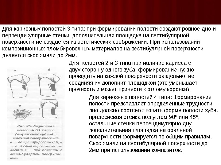 3 класс кариозной полости. 3 Класс препарирование с дополнительной площадкой. Формирование кариозной полости. Формировать дно кариозной полости. Доп площадка кариозной полости.