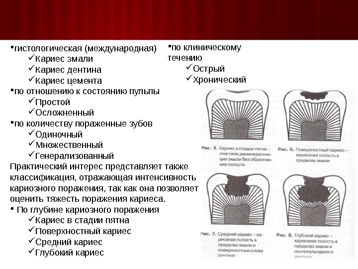 Кариес дентина мкб. Клиническая классификация кариозных полостей. Классификация кариозных полостей гистологическая. Классификация кариеса эмали дентина цемента. Классификация кариеса по отношению к пульпе зуба.