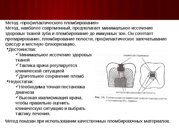 Пломбирование полости. Методика препарирования и пломбирования. Методики пломбирования кариозных полостей. Метод профилактического пломбирования фиссур. Алгоритм пломбирования кариозных полостей.