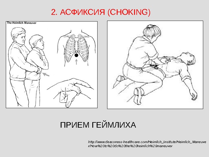 Метод геймлиха. Подавился метод Геймлиха. Прием Генри Геймлиха. Алексей Железнов прием Геймлиха. Метод Геймлиха без сознания.