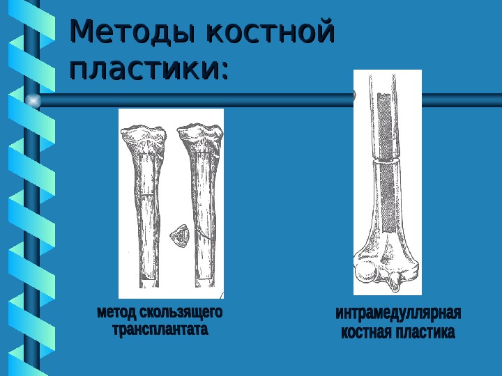 Костная пластика презентация