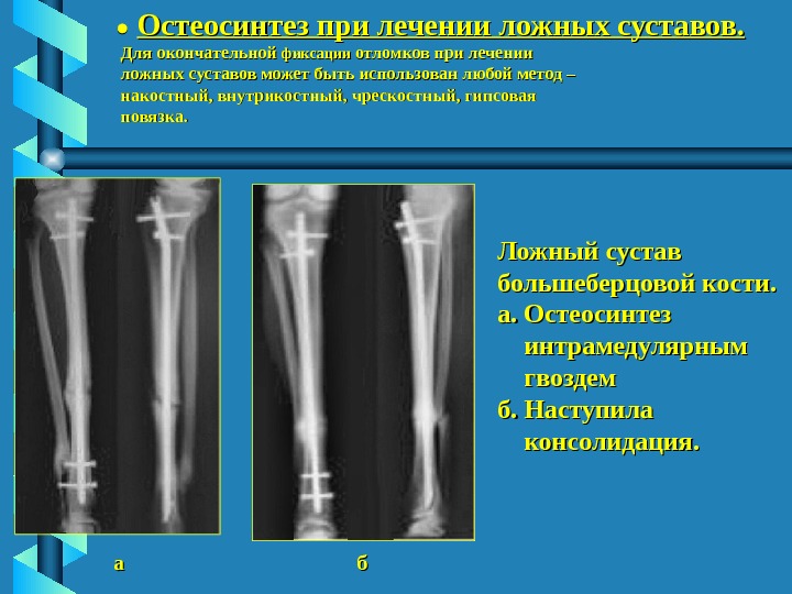 Ложный сустав презентация