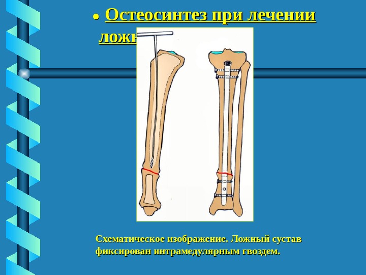 Ложный сустав презентация