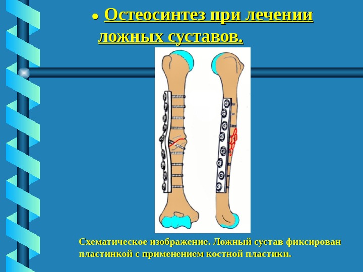 Ложный сустав презентация