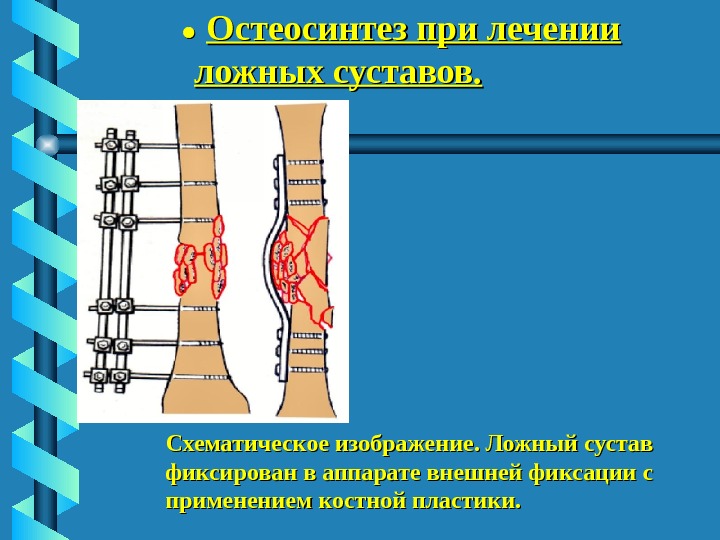 Ложный сустав презентация