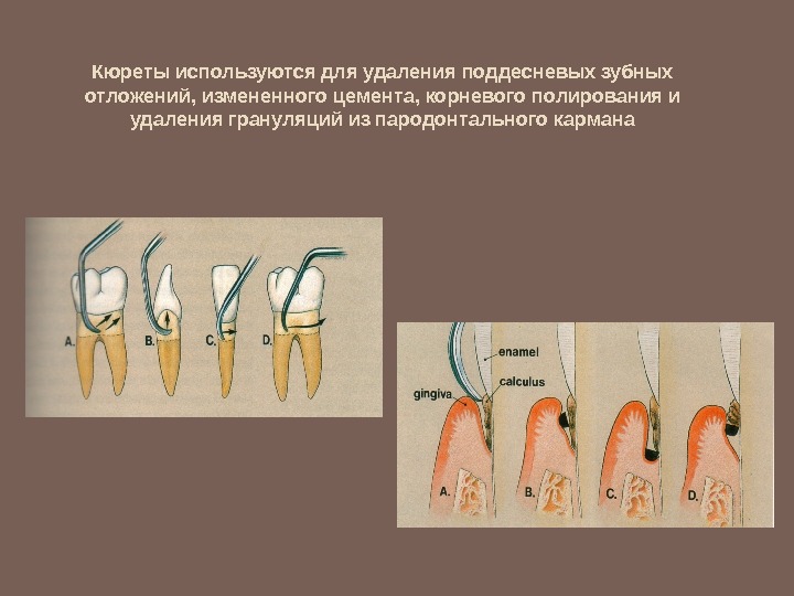 Методы удаления зубных отложений презентация