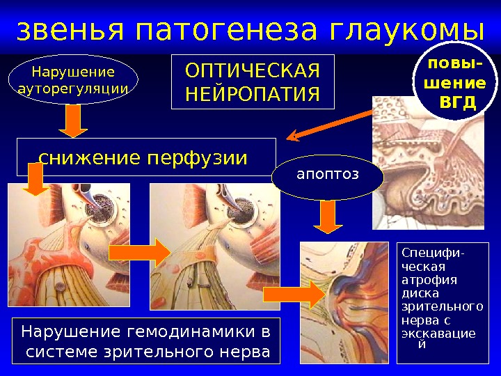 Глаукома картинки для презентации