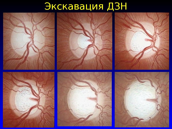 Зрительный нерв при глаукоме