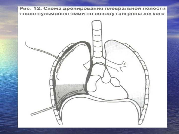 Гнойные заболевания легких и плевры презентация