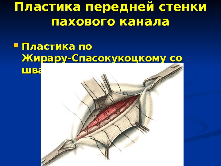 Стенки пахового канала