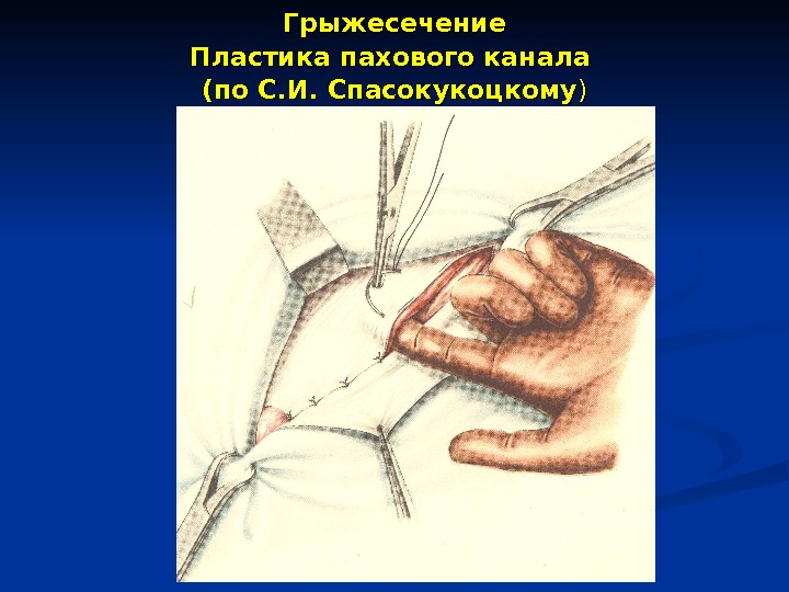 Пластика пахового канала по кимбаровскому