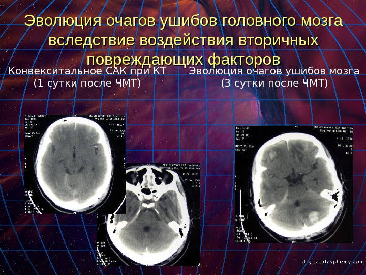 Презентация ушиб головного мозга